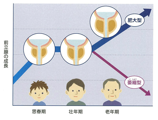 前立腺肥大症（図２）