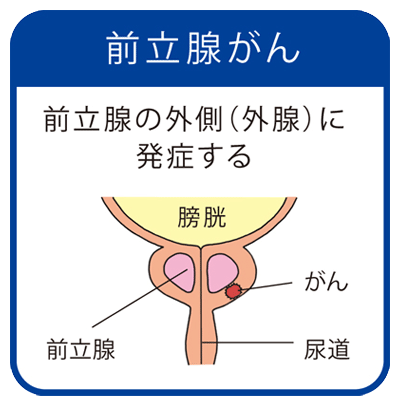 前立腺癌①